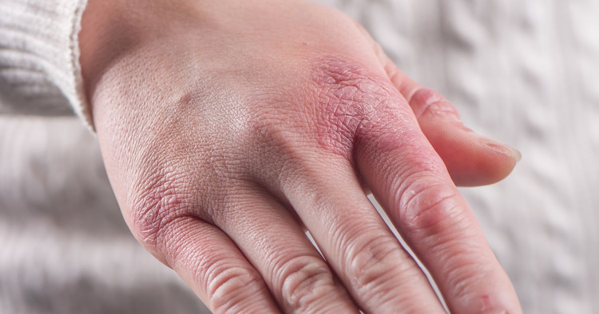 popraskane-ruce-krem-na-popraskane-ruce